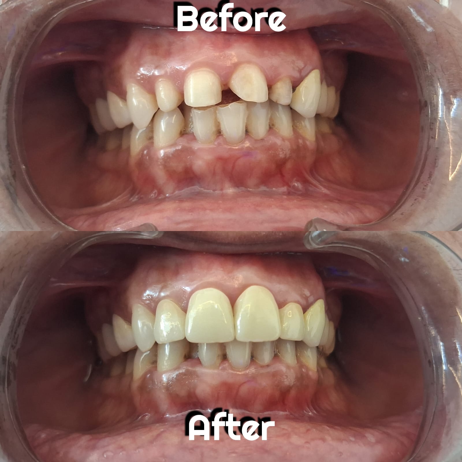 Cosmetic dentistry and smile makeover at Family Dental Clinic Ravet Pune